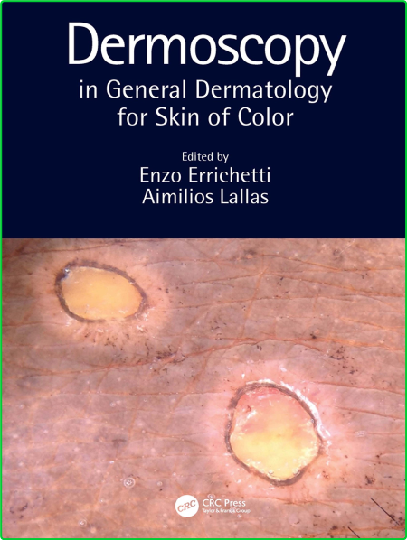 Dermoscopy in General Dermatology for Skin of Color Ada53413935e39dba797737d8dfa0dcd