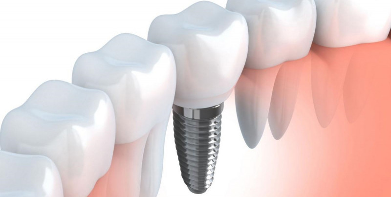 Имплантация зубов в современной стоматологии