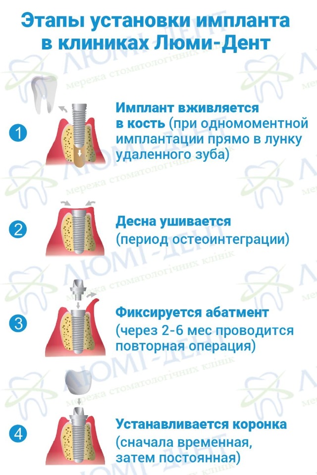 Этапы имплантации зубов схема