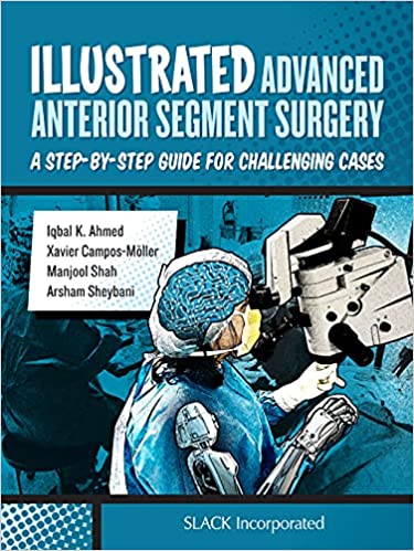 Illustrated Advanced Anterior Segment Surgery A Step-by-Step Guide for Challenging Cases